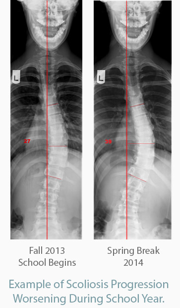 X-rays 6 Month Progression
